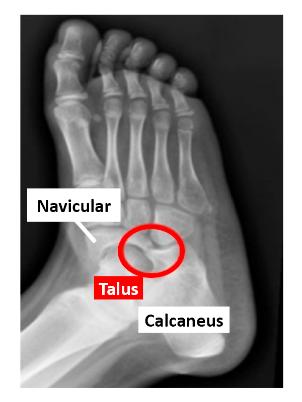 Royal Orthopaedic Hospital Tarsal Coalition